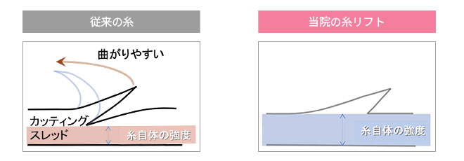 従来の糸 当院の糸リフト