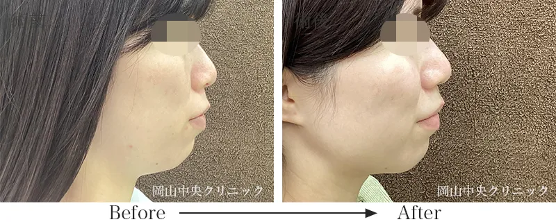 脂肪吸引の症例写真