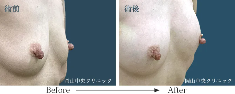 ヒアルロン酸豊胸の症例写真2