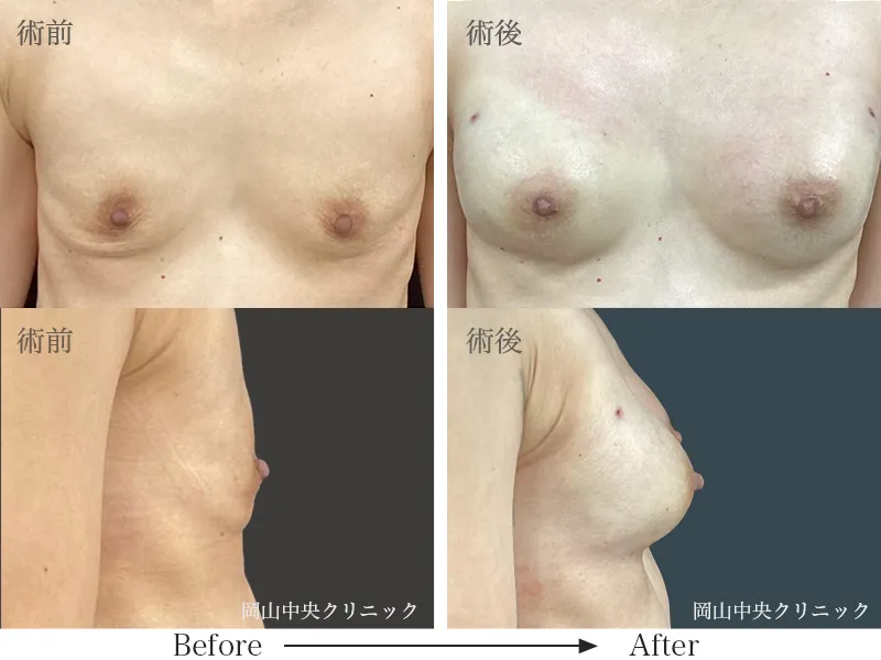 ヒアルロン酸豊胸の症例写真3