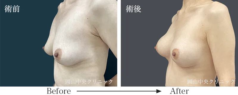 ヒアルロン酸豊胸の症例写真4