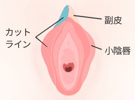 小陰唇縮小 写真