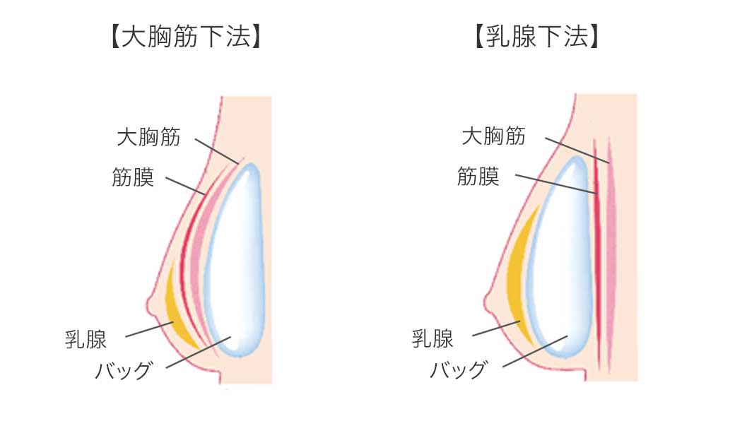 豊胸インプラント