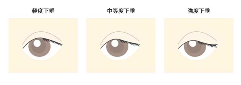 眼瞼下垂イラスト