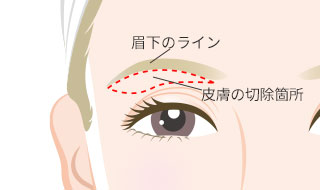 眉下リフト