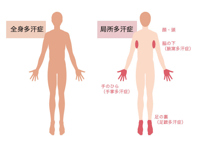 全身性多汗症と局所性多汗症