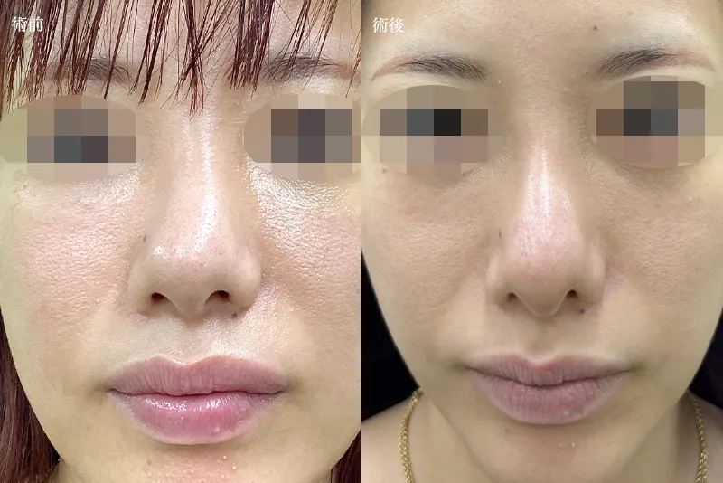 団子鼻改善治療の症例写真